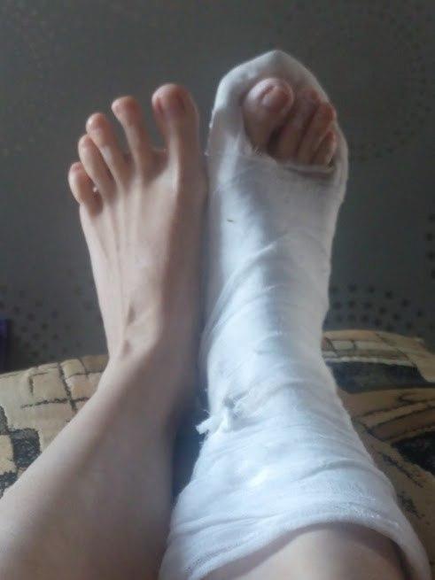 ксюшиному гипсу