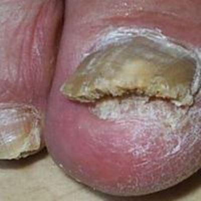 Задолбали этим грибком...